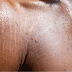 Stretch marks in men